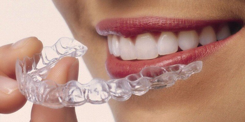 Invisalign